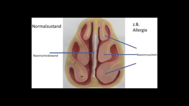 Berliner HNO- Arzt Dr. Josef Thoma über nasale Tests
